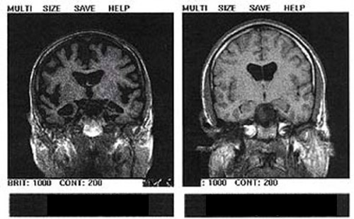 Alzheimer%27s_disease_-_MRI_%28dumb_version%29.jpg
